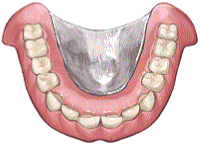 金属床義歯は保険適応外の自費での入れ歯